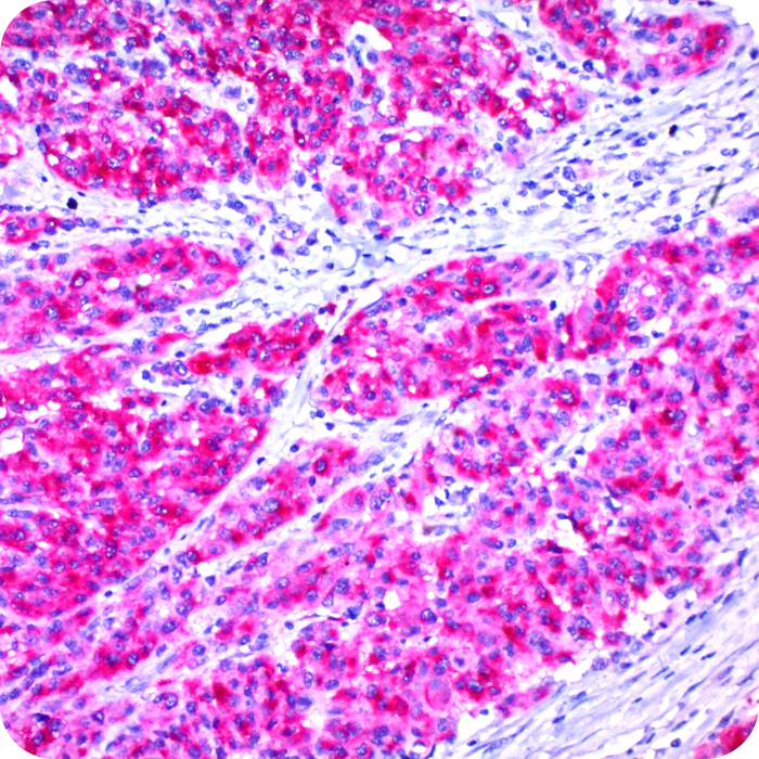 Melanoma; Pan (Concentrate)